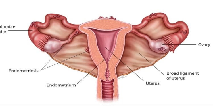 An illustration of endometriosis on the female reproductive systemPHOTO/Cleveland Clinic