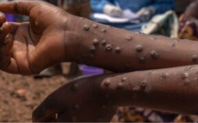 A person with Mpox on their hands PHOTO/BD