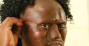 Dormitila face after undergoing nasal surgery at KNH. PHOTO/KNH FB