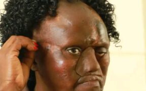 Dormitila face after undergoing nasal surgery at KNH. PHOTO/KNH FB