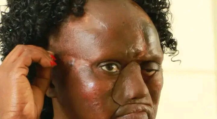Dormitila face after undergoing nasal surgery at KNH. PHOTO/KNH FB