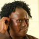 Dormitila face after undergoing nasal surgery at KNH. PHOTO/KNH FB