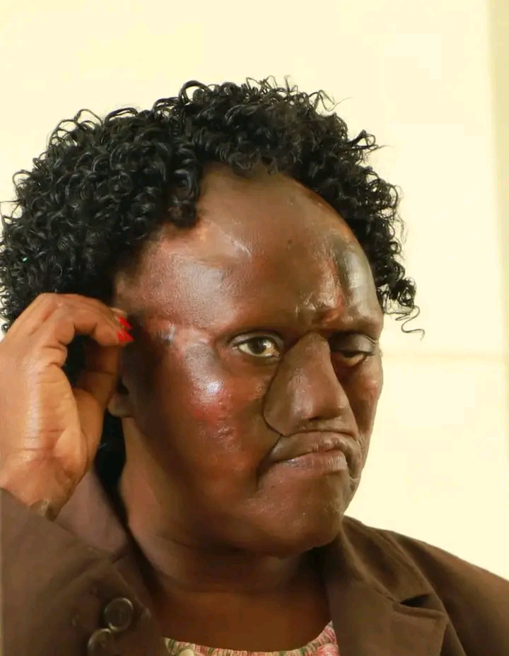 Dormitila face after undergoing nasal surgery at KNH. PHOTO/KNH FB