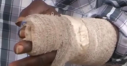 A photo af a man who was bitten by the attacker PHOTO/KBC