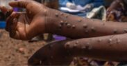 A person with Mpox on their hands PHOTO/BD