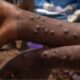 A person with Mpox on their hands PHOTO/BD
