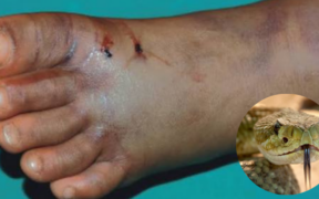Photo showing a person after being bit by snake and insertion of the snake . Photo/ Courtesy