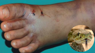 Photo showing a person after being bit by snake and insertion of the snake . Photo/ Courtesy
